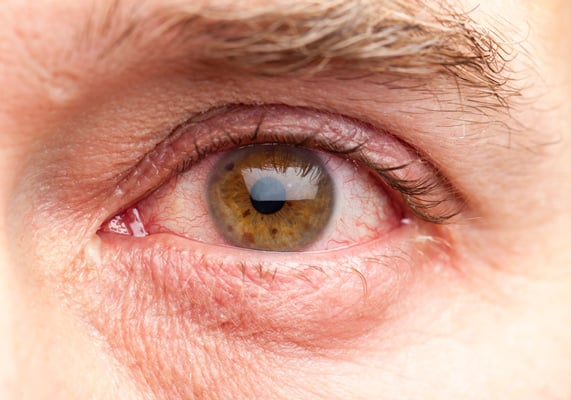 фотография покраснения глаз при аллергии